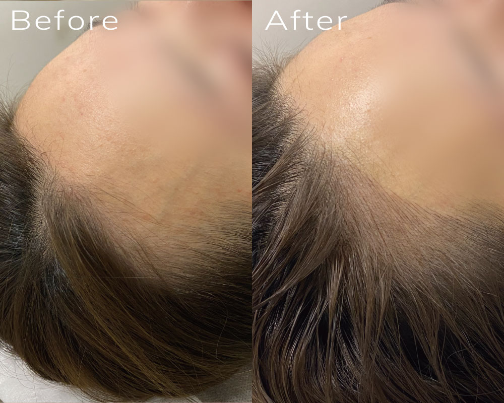 ヘアラインアートメイクのビフォーアフター症例