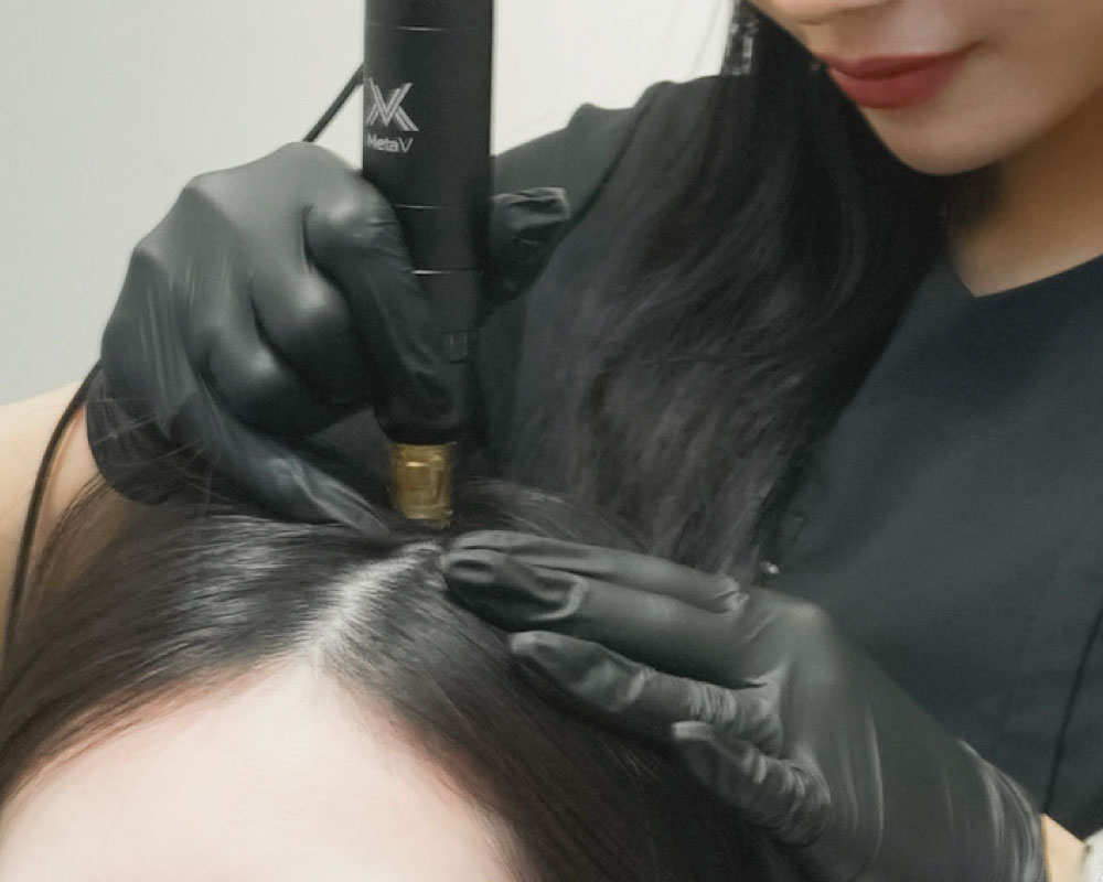スカルプエアの施術