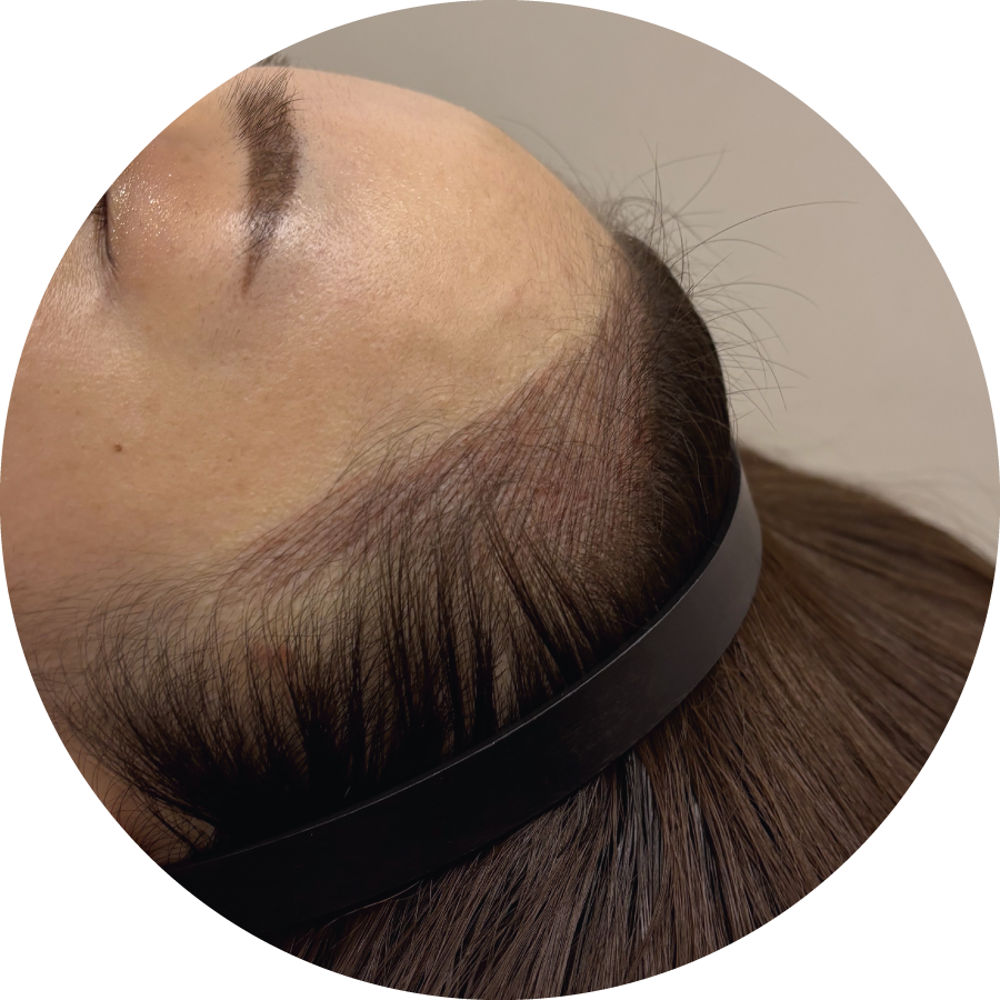 ヘアラインアートメイクの症例