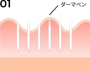 ダーマペンのメカニズム