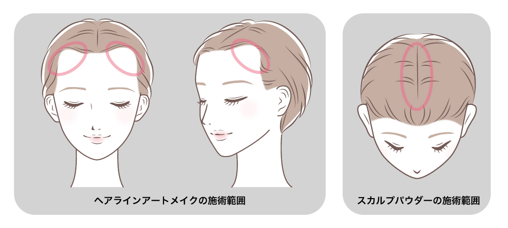 ヘアラインアートメイク 