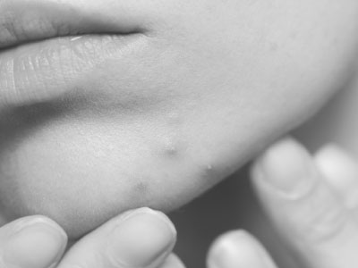 ピコフラクショナル