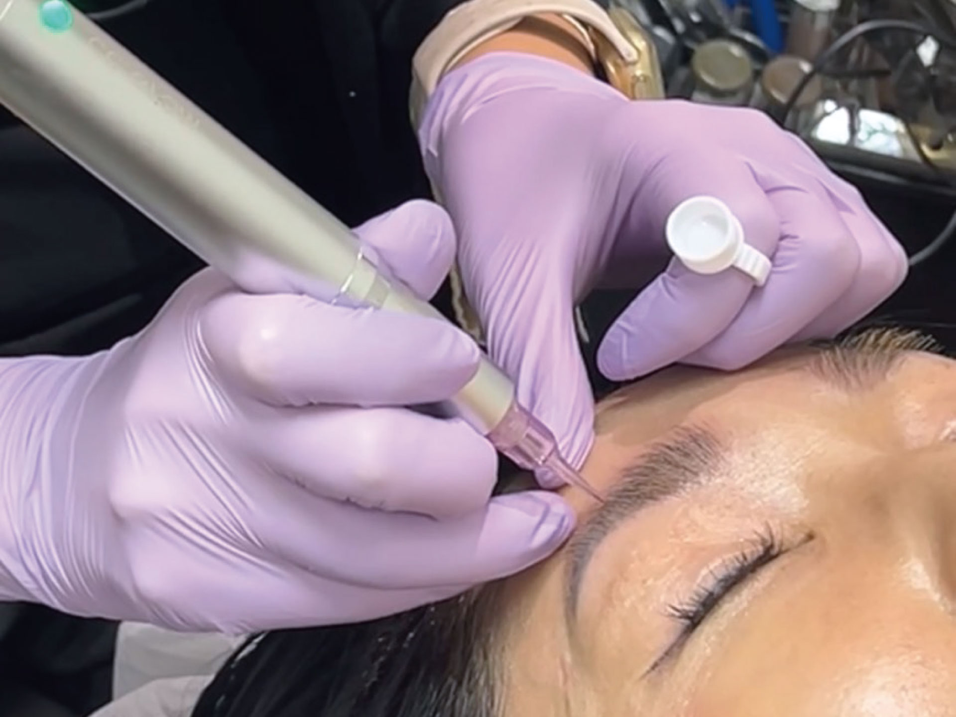 アートメイク薬剤除去