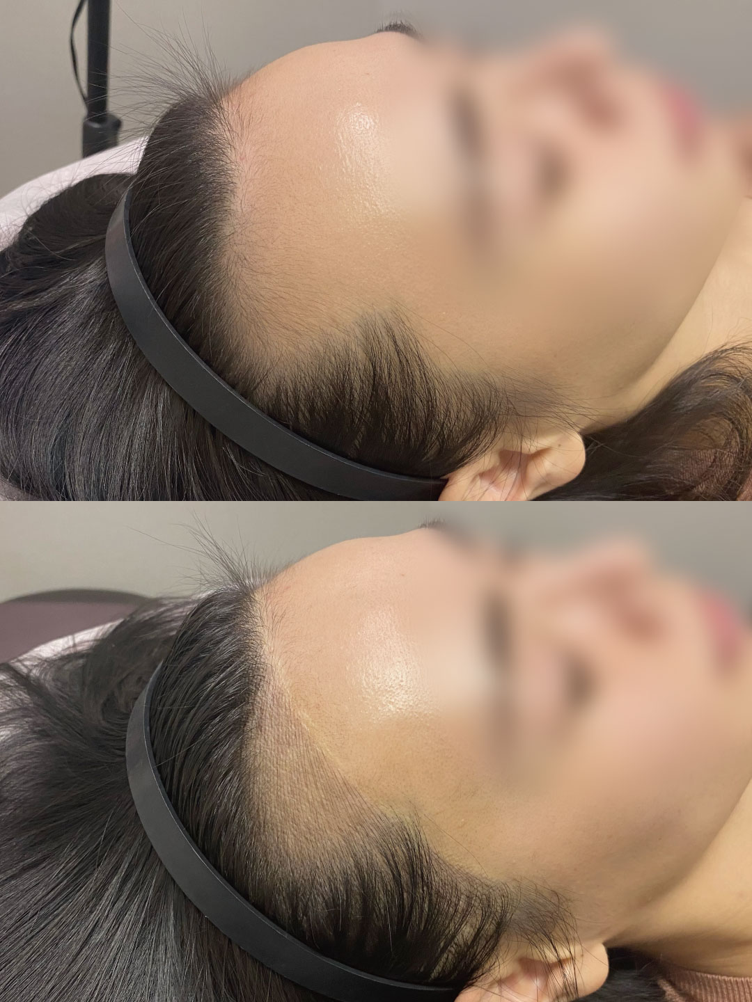 ヘアラインアートメイク①
