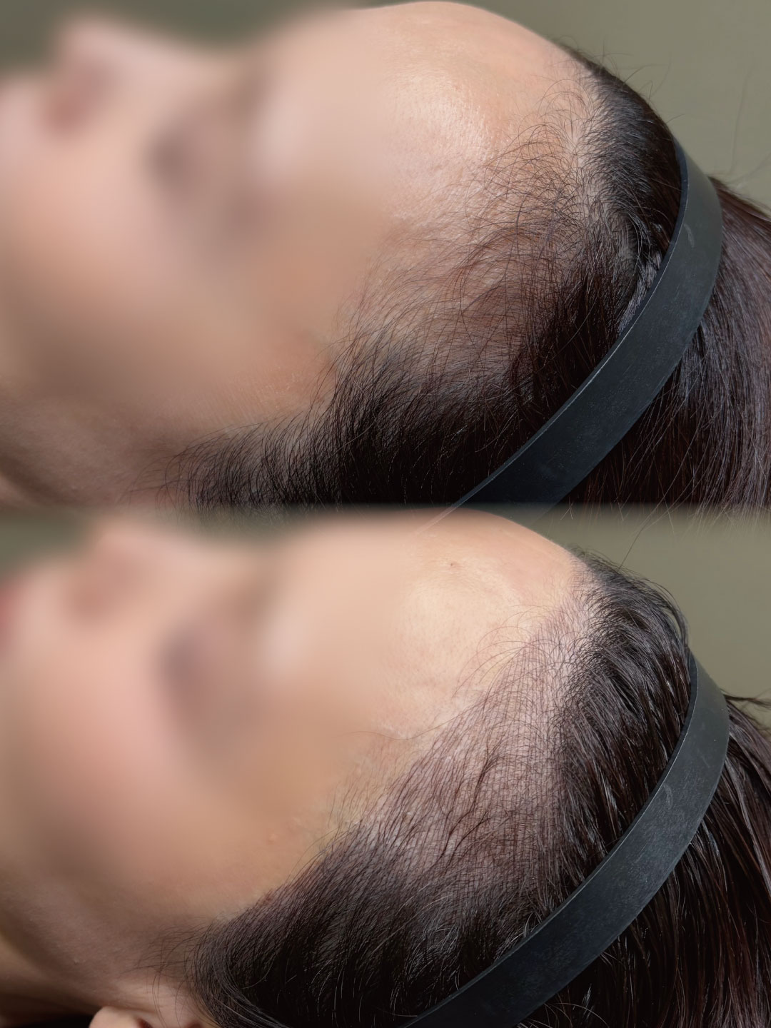ヘアラインアートメイク②